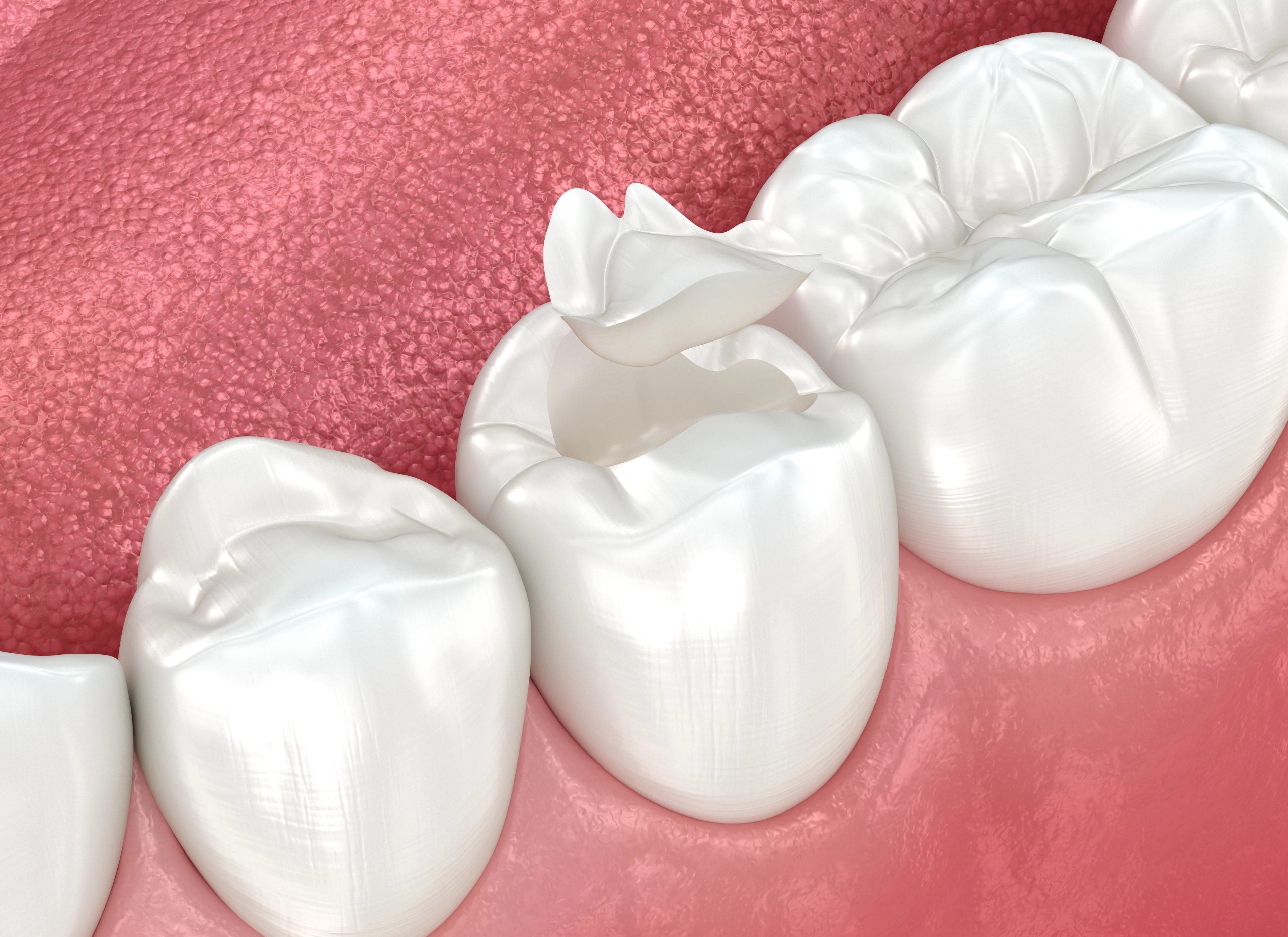 Dental Sealants Aftercare: Keeping Your Protection Effective